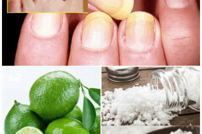 Tired of stubborn toenail fungus making your nails yellow, thick, or brittle? Nature has an easy, effective remedy you can try at home using two powerful ingredients: lemon and salt.